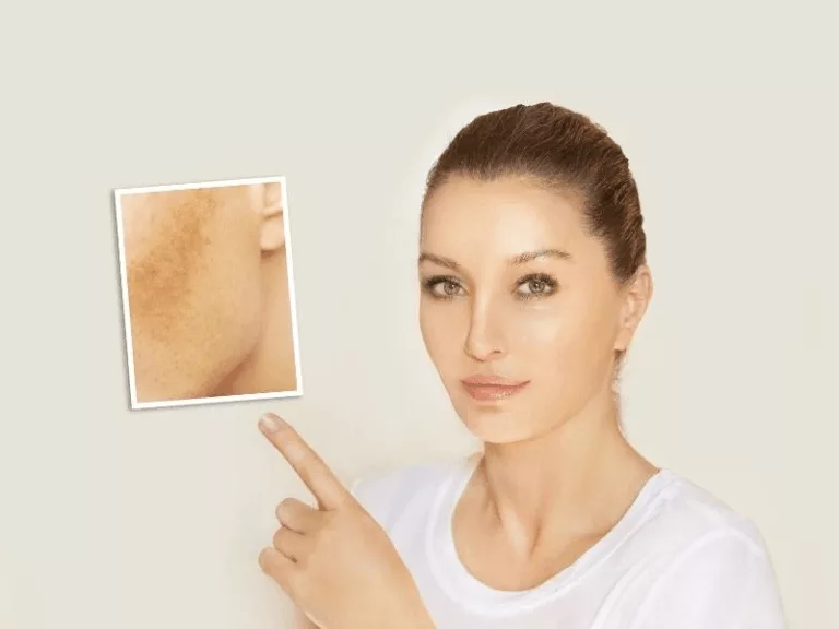 3 Essential Oils for Sunburns